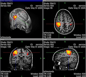 Overview of the different levels of observation of a fMRI-scan after left finger tapping. The color-coded area is an indication of increased brain activity. Image: M.R.W.HH at de.wikipedia (Public domain), Wikimedia Commons