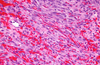 Mikroskopische Aufnahme eines Kaposi-Sarkoms. Foto: Michael Bonert, Wikipedia, CC BY-SA 3.0