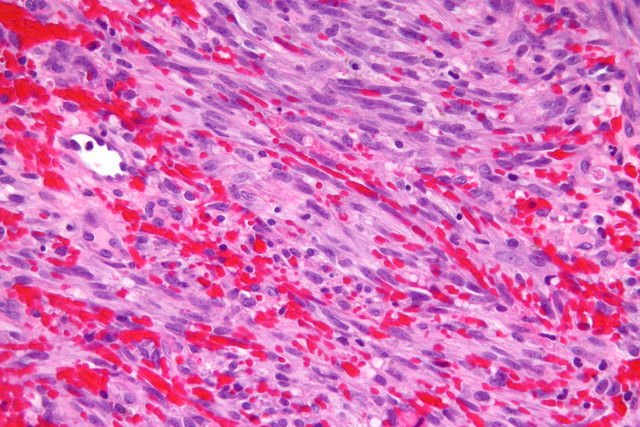 Mikroskopische Aufnahme eines Kaposi-Sarkoms. Foto: Michael Bonert, Wikipedia, CC BY-SA 3.0