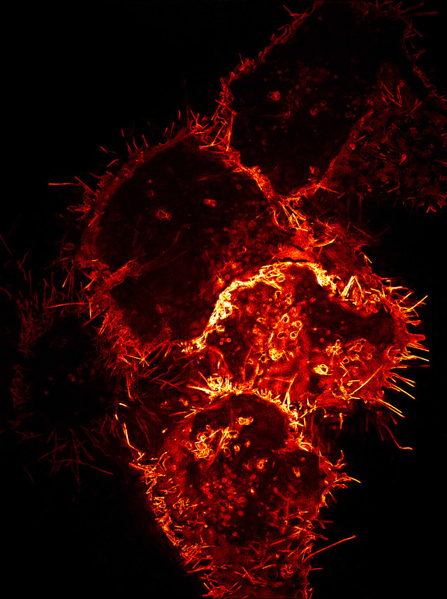 Menschliche Zellen, die Virosomen produzieren. Foto: Universitätsklinikum Tübingen 