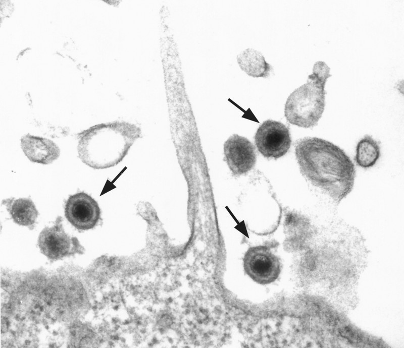 Mikroskopische Aufnahme von Kaposi-Sarkom-Herpesviren in einer PEL-Krebszelllinie. Foto: Dharam et al. 2002, Clinical Micobiology Reviews 15(3), DOI: 10.1128/cmr.15.3.439-464.2002, reproduced with permission from American Society for Microbiology