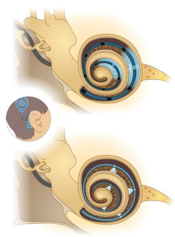 Ein akustisches Cochlea-Implantat (oben) und ein optisches Cochlea-Implantat (unten) im Vergleich: Da sich Licht besser fokussieren lässt, verspricht die optogenetische Stimulation der Spiralganglionneurone der Cochlea eine bahnbrechende Verbesserung der