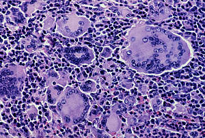 An accumulation of giant cells in the lympph node of a rhesus macaque, caused by an SIV-infection. Image: Franz-Josef Kaup