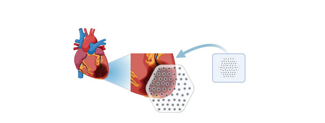 Schematic illustration of the application of a heart patch. Figure: Bobbie Smith