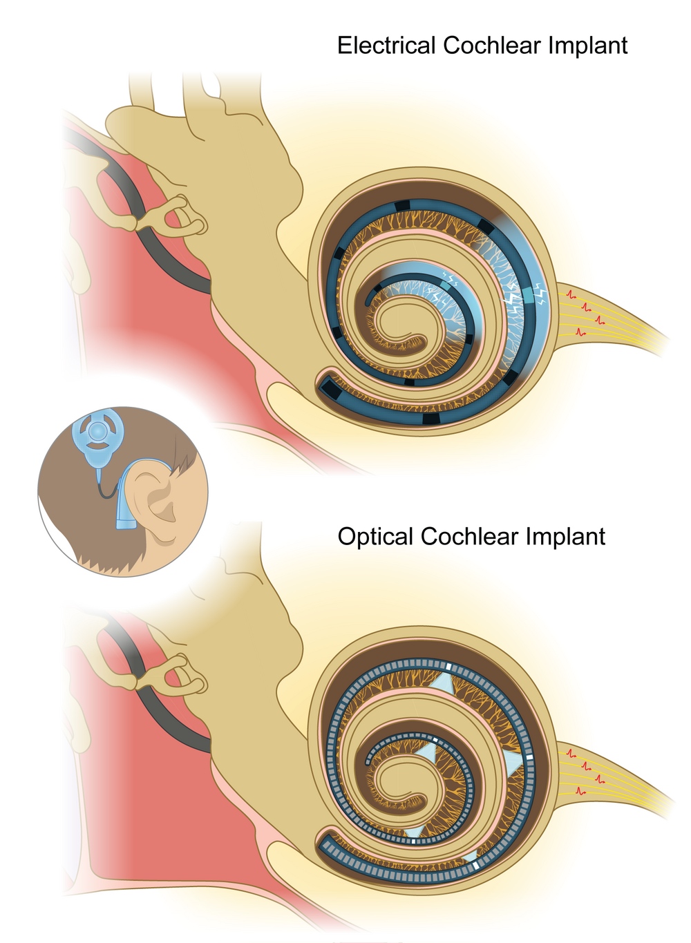 An optical cochlear implant compared with an electrical cochlear implant.